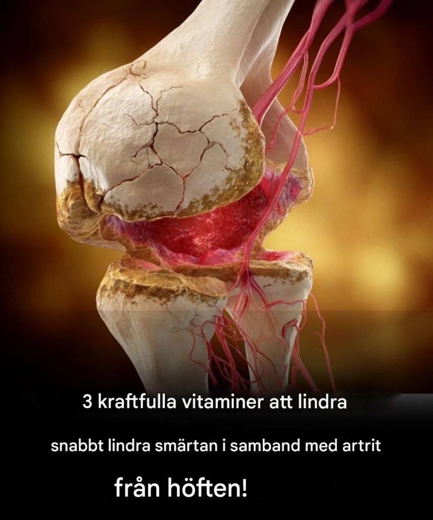 De 3 viktigaste vitaminerna för höftartrit!