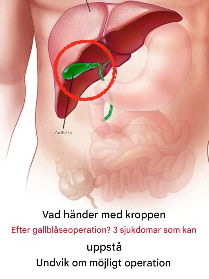 Vad händer med din kropp efter gallblåseborttagning? 3 sjukdomar som kan orsaka gallblåseborttagning – Undvik operation om möjligt