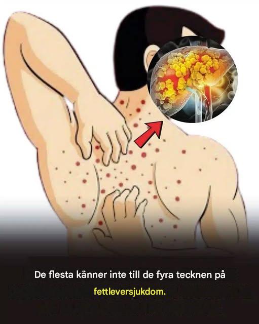 188 😱 Fettleversjukdom (hepatisk steatos): orsaker, symtom, behandling och huskurer 🌿 Vad du behöver veta för att skydda din lever, se mer i den första kommentaren 👇 👇