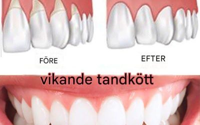 Tandköttssjukdom: Den tysta mördaren, 8 huskurer för att bota det naturligt