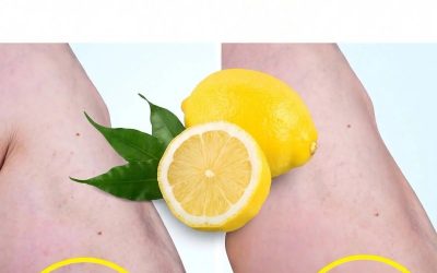 Citron eliminerar åderbråck! Gör detta varje dag…