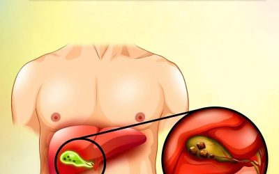 5 vitaminer för att lösa upp dina gallstenar…