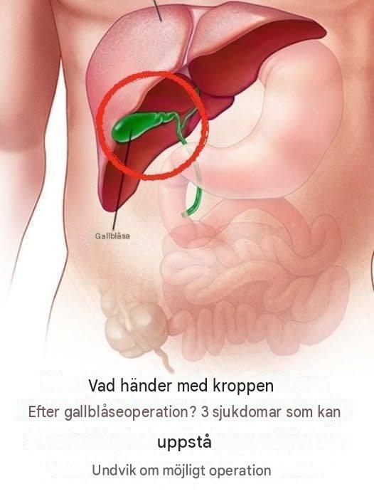 Vad händer med kroppen efter gallblåseoperation? 3 möjliga komplikationer