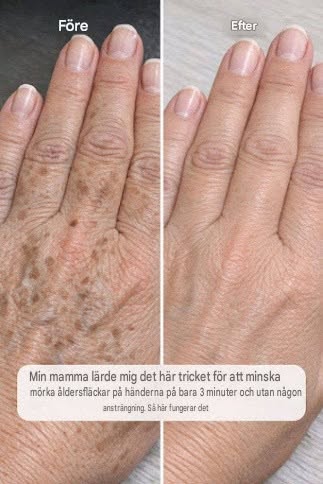 Min mamma lärde mig det här tricket för att minska mörka åldersfläckar på händerna på bara 3 minuter utan någon ansträngning. Så här fungerar det.