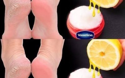 Torra och spruckna hälar – så vårdar du dem skonsamt hemma
