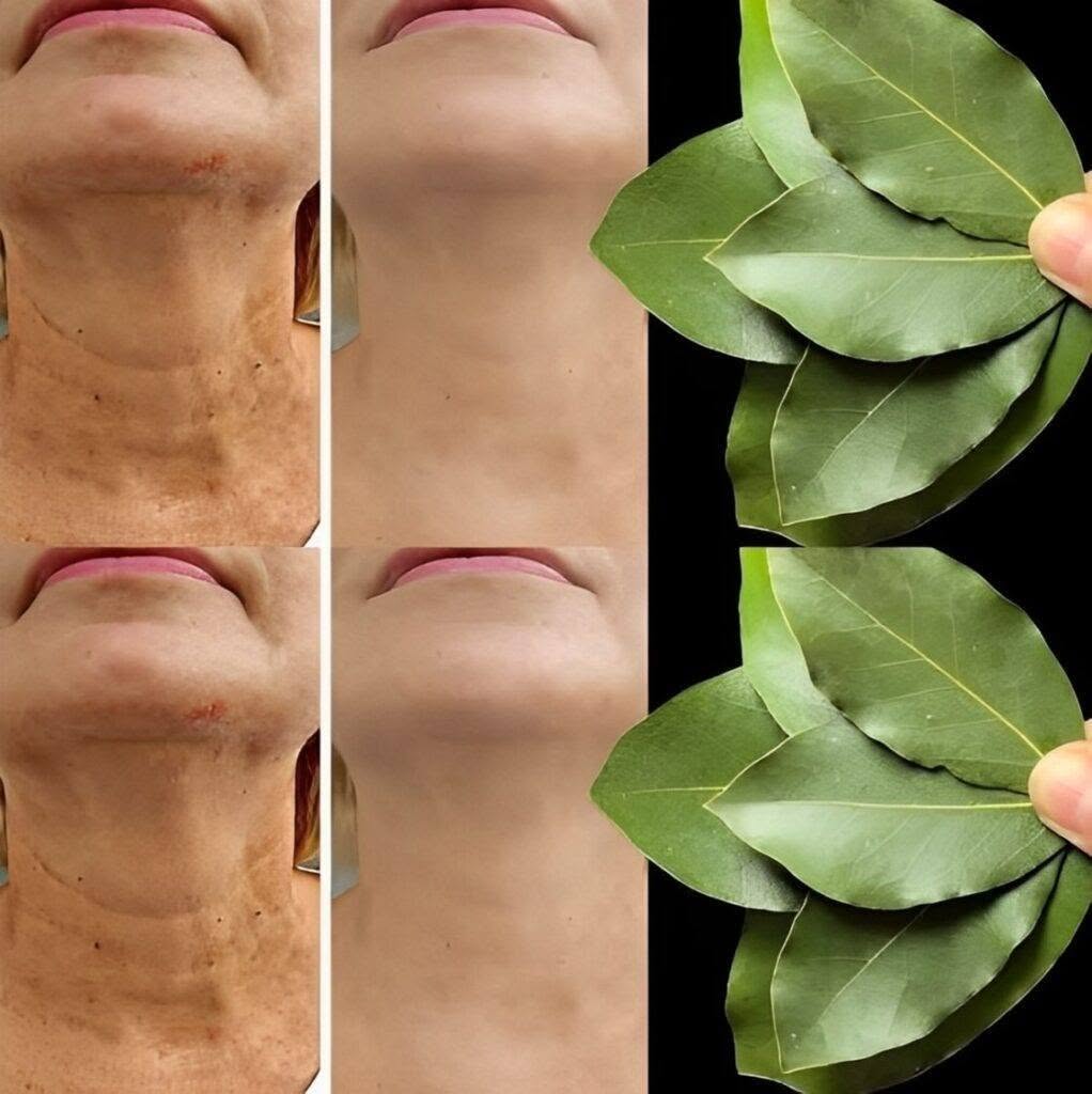 Är lagerblad 100 000 gånger kraftfullare än Botox? | Ett naturligt botemedel mot rynkor, även vid 70!