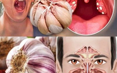 Vitlök mot infektioner: 12 bevisade fördelar och hur man använder den naturligt