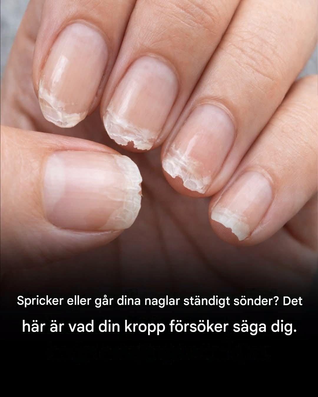 Sköra eller ömtåliga naglar: vad din kropp försöker säga dig