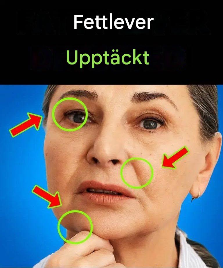 Alla med fettlever har detta gemensamt! Ett dolt tecken du borde känna till.