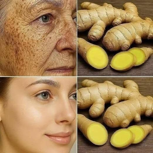 Ingefära är 100 gånger effektivare än Botox på att eliminera djupa rynkor, fräknar och missfärgningar. Jag måste säga något så att du kan fortsätta få mina recept… Tack!