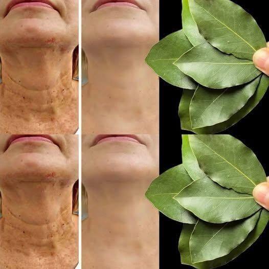 Bay Leaf Is 100,000 Times Stronger Than Botox? | Natural Wrinkle Eraser Even at Age 70!
