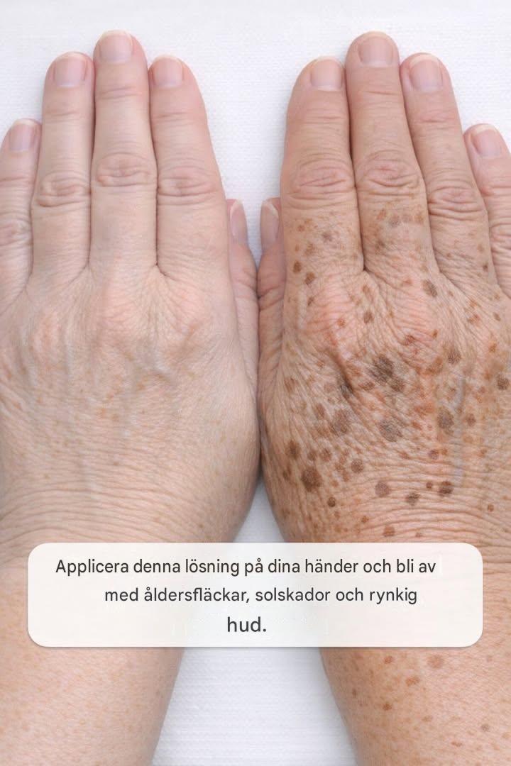 Applicera denna lösning 1 på dina händer och bli av med åldersfläckar, solskador och krämig hud.