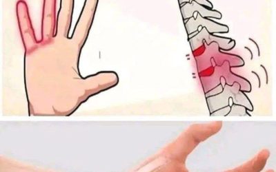 ⚠️ Vad det är: Karpaltunnelsyndrom
