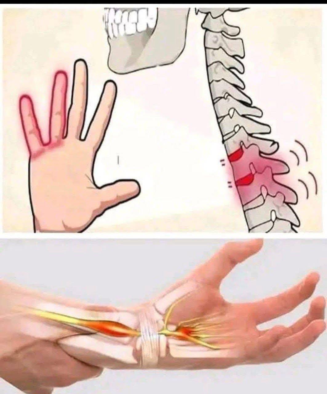 ⚠️ Vad det är: Karpaltunnelsyndrom